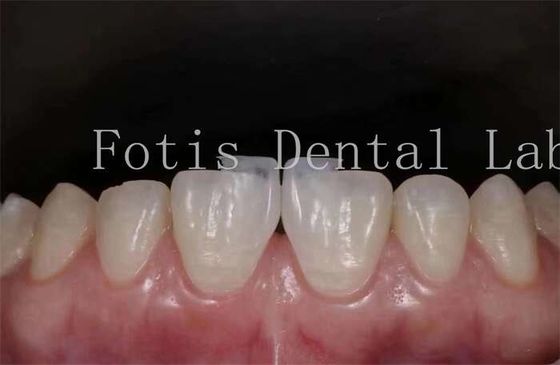 Polire finiture di laminato dentale sintetico ad alta resistenza alle macchie