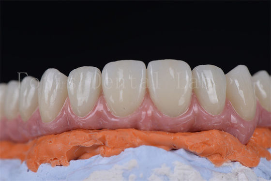 Innovativi impianti dentali minimamente invasivi tutti su 4 tutti su 6 in 1-2 settimane