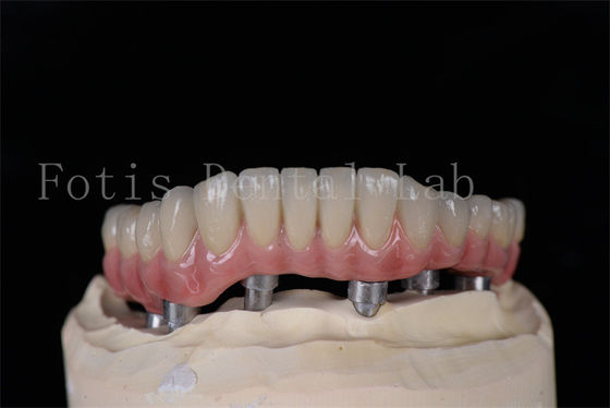 Minimalmente invasivo Lo stesso giorno tutti su 4 tutti su 6 impianti naturale facile da pulire