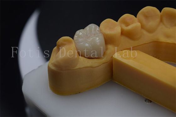 Corona protesi di titanio / PFM Customizabile Corona di impianto di zirconia Durable