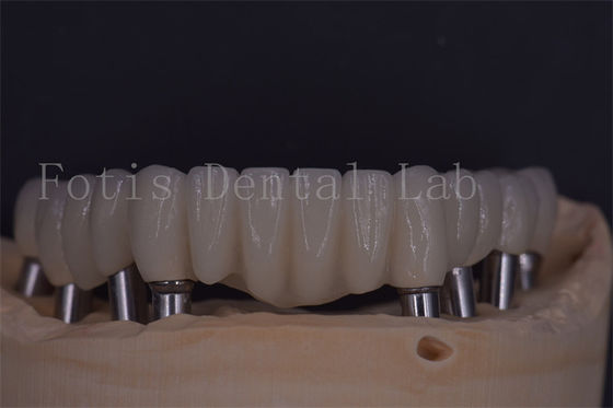 Corone dentarie affidabili per il comfort e la funzionalità