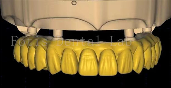 Il design di una corona dentale OEM utilizza una tecnologia avanzata di scansione e stampa 3D