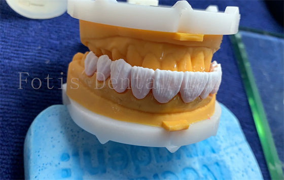 Corone dentali digitali avanzate Impianto corone dentale FDA/ISO/CE Certificato