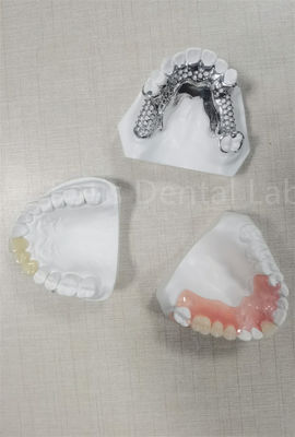 Durabile, flessibile, rimovibile, parziale, facile da pulire, sostituisce i denti mancanti