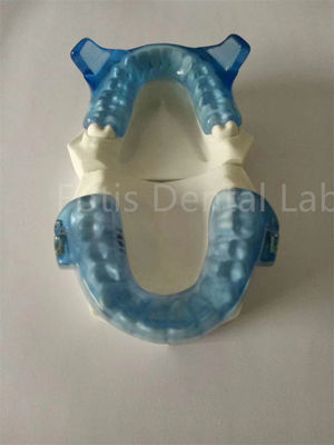Apparecchiatura ortodontica avanzata per risultati di allineamento dei denti superiori