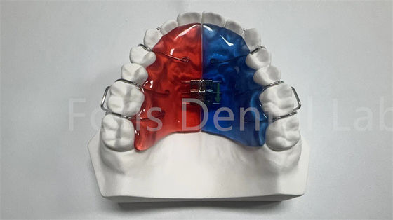 Espansore ortodontico individuale per la correzione e il miglioramento dentale