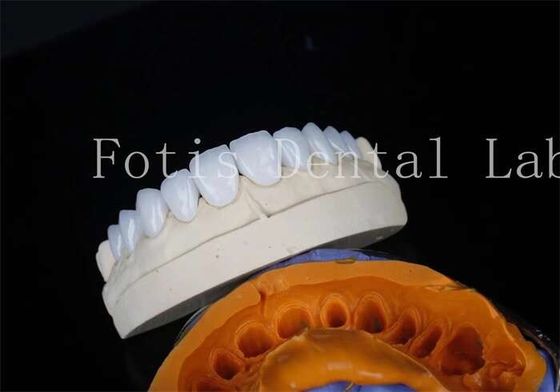 comprare Porcellana di laboratorio dentale finiture di cemento di legame per restauri duraturi online manufacture