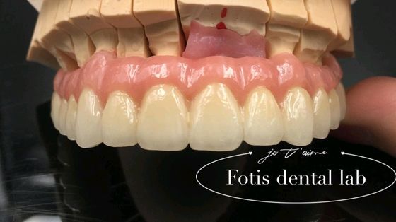 Restauro affidabile PFM corone dentali porcellana fusa a corona metallica personalizzata