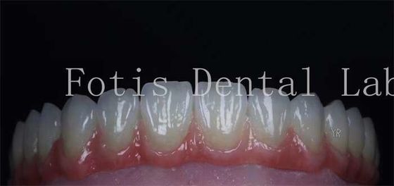 Superficie liscia rivestimenti dentali cosmetici finiture di porcellana naturale personalizzabili