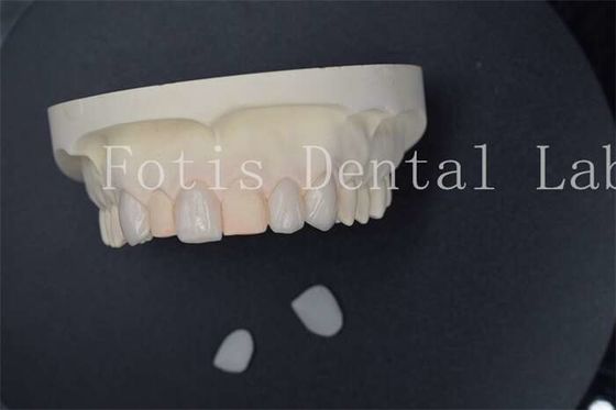 Finiture di laboratorio dentale artificiale su misura con resistenza alle macchie superiore