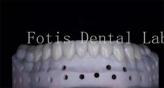 OEM ODM Resistente alle macchie Veneer di porcellana di aspetto naturale Alta resistenza