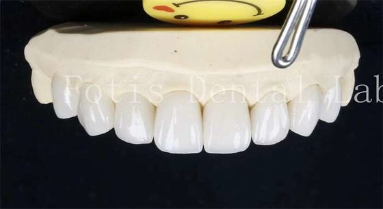 0.3-0.5mm denti in ceramica laminata vene false denti con cemento adesivo