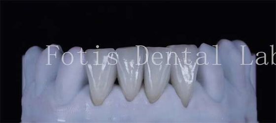 Sottili denti di rivestimento in laminato sintetico spessore 0,3-0,5 mm Belle aspetto