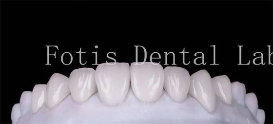 Polire finitura cosmetica veneer dentale copri per un bel sorriso