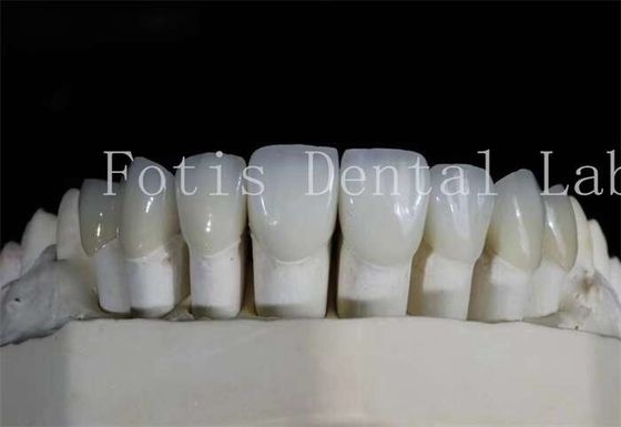 Finiture di laminato dentale lucido ad alta traslucidità per sorrisi naturali