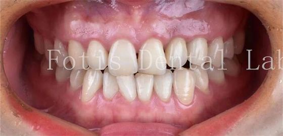 Dentistica cosmetica Finiture di porcellana dentale con elevata resistenza alle macchie