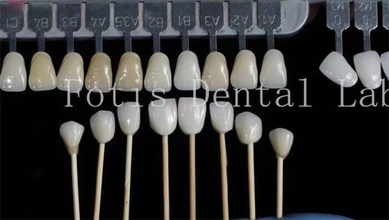 Personalizzazione Finiture dentali naturali Denti finti sovrapposti Alta resistenza