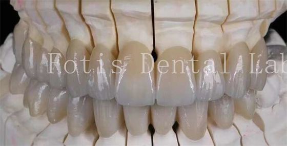 Sorriso naturale Protesi di porcellana rivestimenti laminati Superficie liscia