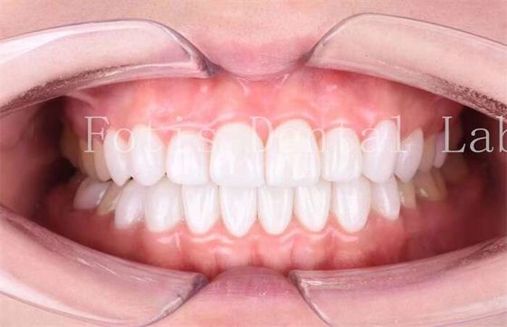 Finitura di lucidità elevata di finiture di laminato dentale