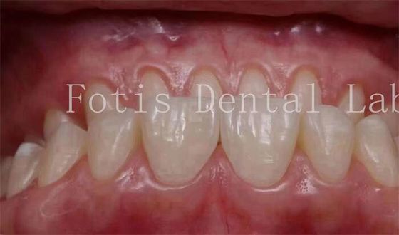 0.3-0.5mm Spessore denti cosmetici copre finiture per la dentistica cosmetica