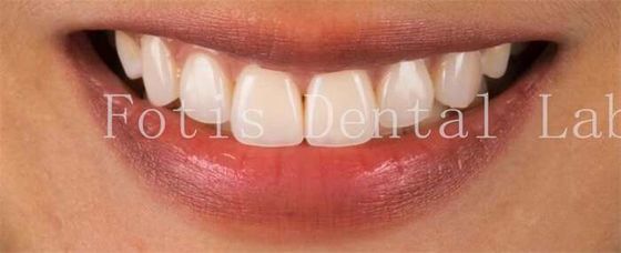 Finestre dentistiche cosmetiche di fascia alta per una perfetta resistenza alle macchie del sorriso