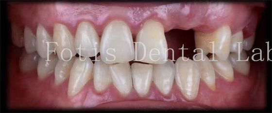 Finestre dentali temporanee naturali personalizzate per un bel sorriso