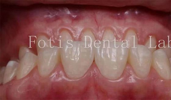 Dispositivi personalizzati di aspetto naturale con rivestimenti di 0,3 mm - 0,5 mm di spessore