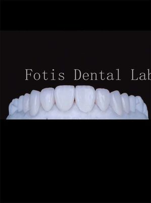 I rivestimenti dentali in porcellana di alta traslucidità migliorano il tuo sorriso