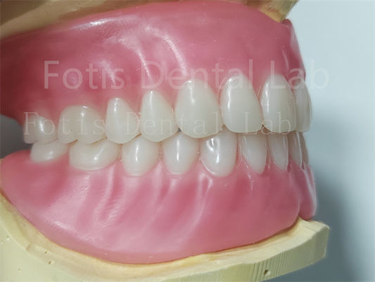 Denti Ivoclari Protesi dentale acrilica completa Facile da pulire Alta durata
