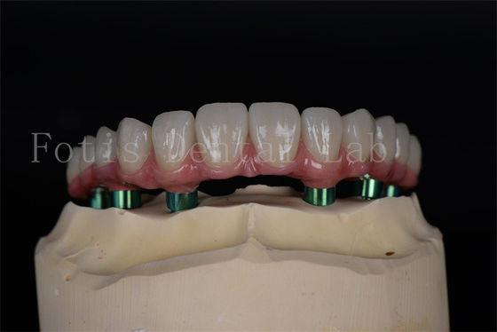 Titanio/Zirconia di lunga durata Tutti su 4/6 impianti Facile manutenzione Alto tasso di successo