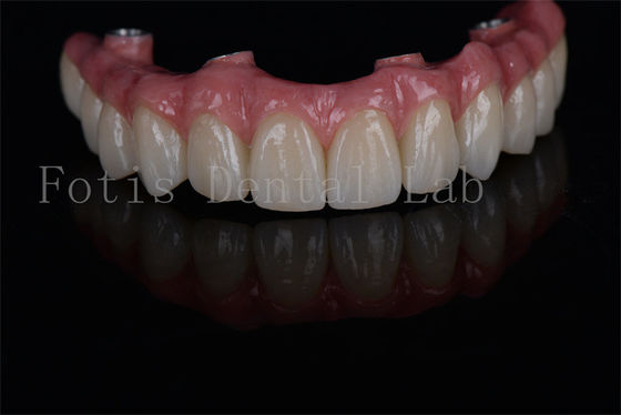 Impianti dentali all on 4 all on 6 di lunga durata minimamente invasivi e facili da mantenere per esigenze di bassa densità ossea