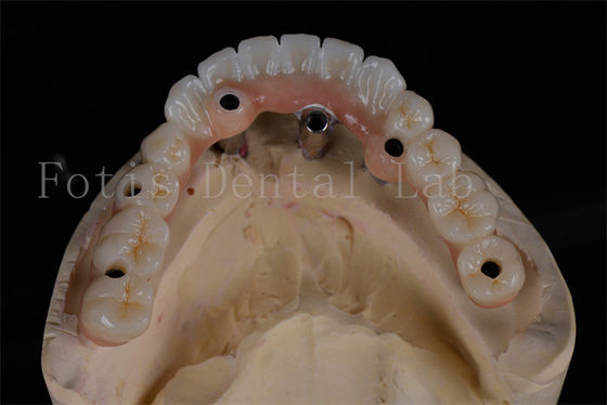 Tasso di successo Implantazione dentale all-on-4 Procedura dello stesso giorno A prezzi accessibili Ripristino completo della masticazione