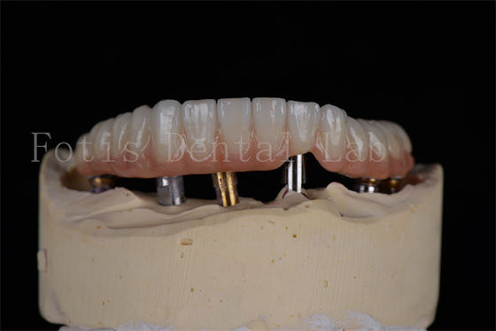 Affidabile aspetto naturale 4 o 6 impianti di arco completo tasso di successo Soluzione minimamente invasiva