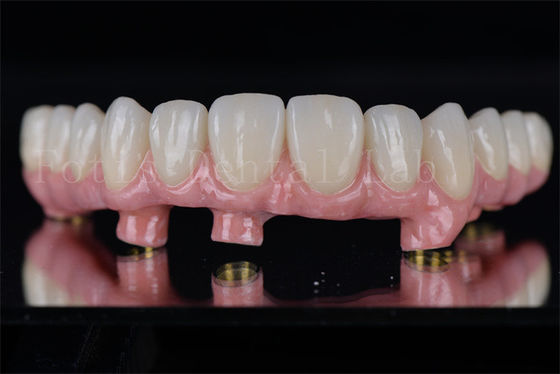 Impianti dentali individuali tutti su 4 tutti su 6 ripristina la piena capacità di masticare