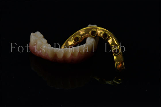 Titanio Zirconia All On 4 All On 6 Impianti Full Smile Impianti Garanzia a vita