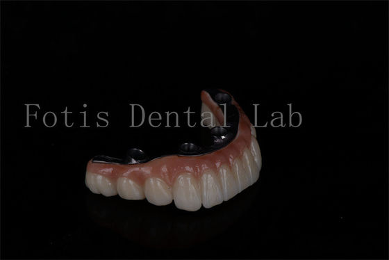 Nessun limite di età A prezzi accessibili Tutti su 6 Impianti di zirconia Facile manutenzione
