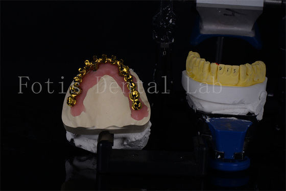 Affordable Titanio / Zirconia All On 4 impianti dentali per sorrisi naturali