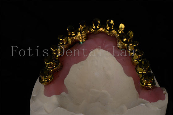 Naturalmente appare tutto su 4 tutti su 6 Impianti dentali ripristinano la piena capacità di masticare