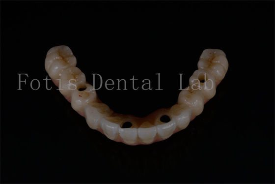 Sostituzione di impianti dentali avanzati per una funzionalità ottimale