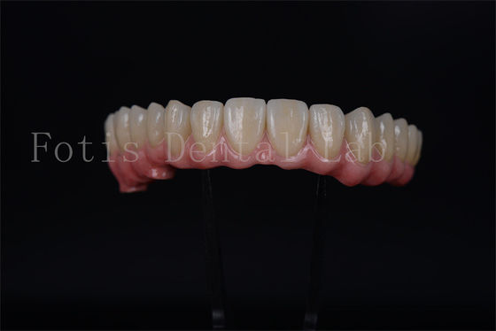 Ponte d'impianto a arco completo tutto su 4 tutto su 6 per il restauro completo dei denti