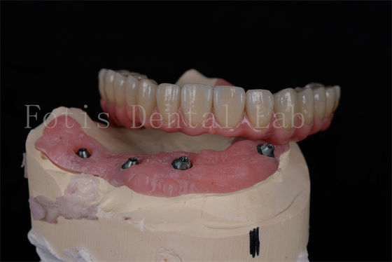 Impianti dentali personalizzabili per la riabilitazione orale completa