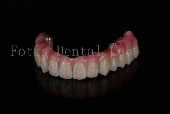 Ripristino dell' arco completo tutti su quattro impianti per prestazioni ottimali degli impianti dentali