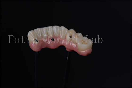 Individuale All On 4 All On 6 impianti endosteali per la sostituzione immediata dei denti