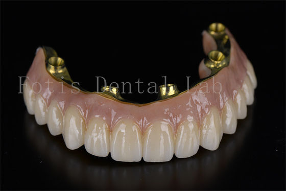 Trattamento professionale efficace con 6 impianti per problemi dentali