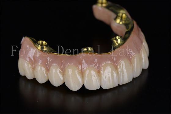 Ricostruzione completa della bocca All On 4 All On 6 Impianto dentale