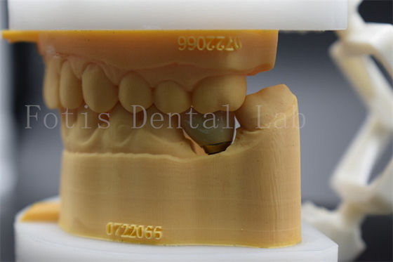 Corone di laboratorio dentali lucide di lunga durata, adattabile con precisione, confortevole per i pazienti