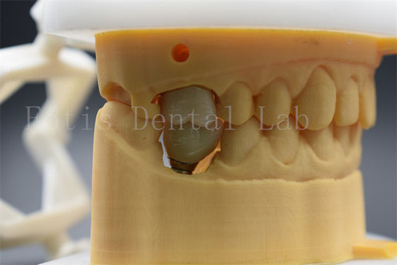 Impianto dentale personalizzabile abutment corona confortevole per i pazienti