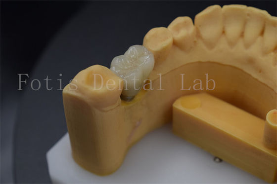 Corone confortevoli e durature per l'impianto dentale per la riparazione dei denti mancanti