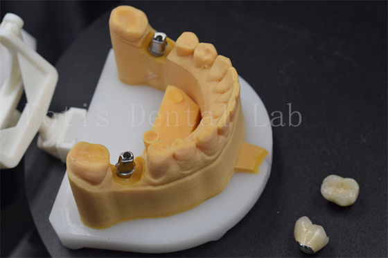Corone per denti in zirconia facile da posizionare Corone per denti in titanio personalizzate