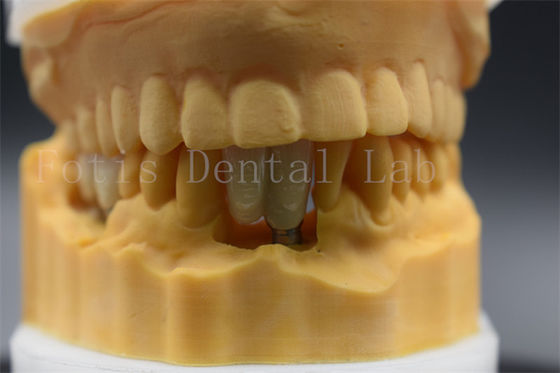 Impianto dentale su misura corone di precisione adatta per denti mancanti